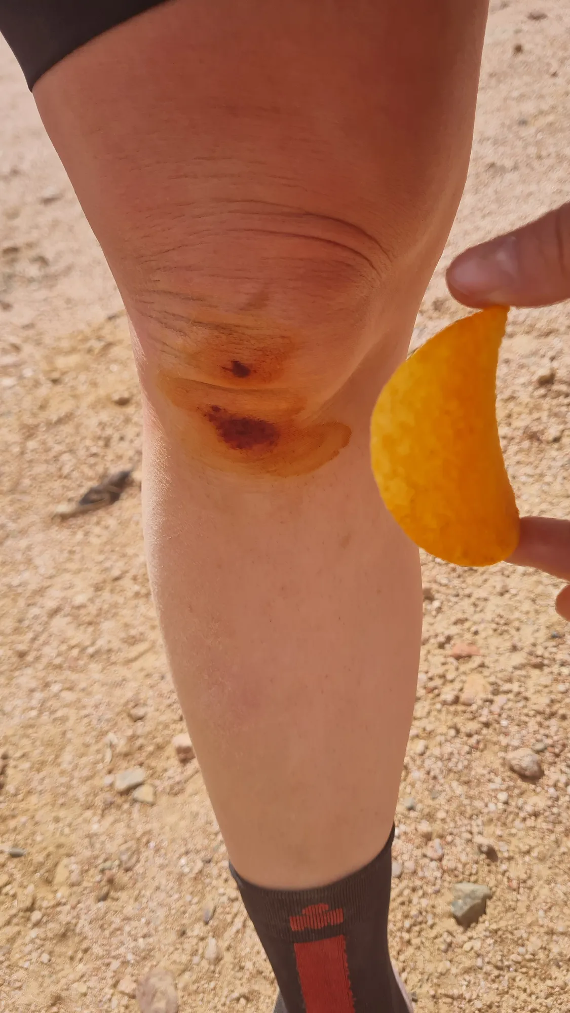 Grazed knee after a fall in the sand
